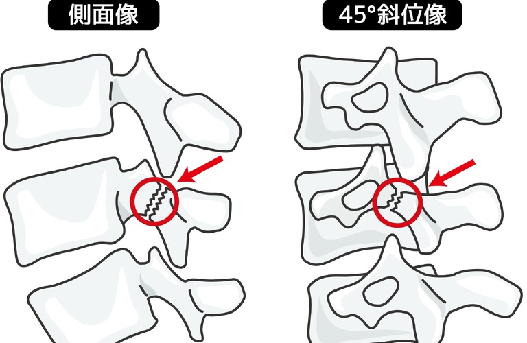 その腰痛、ただの腰痛ではないかも！？腰椎分離症について｜福島県いわき市の接骨院ならかこいスポーツ接骨院